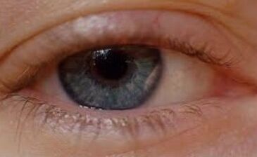 Blefaritis curada con Oculax